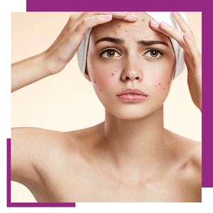 Acne-Treatment_book_now